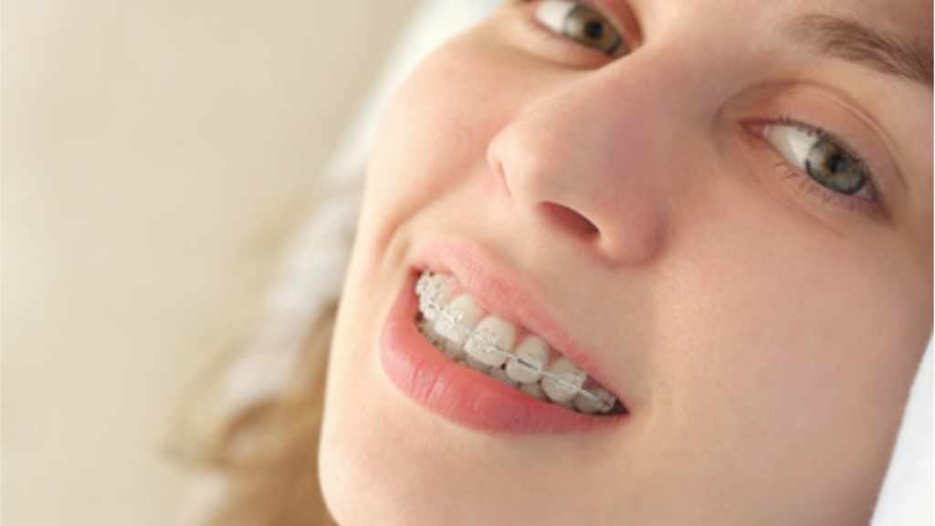 adult braces in noblesville