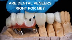 dental-veneers-deldardental-noblesville