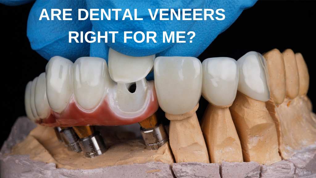 dental-veneers-deldardental-noblesville