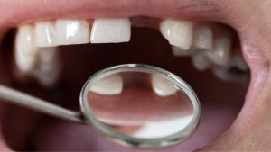 dental-implants-missing-teeth-deldardental-noblesville