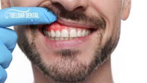 gum-disease-deldardental-noblesville